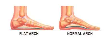 Flat arch foot vs normal arch foot illustration