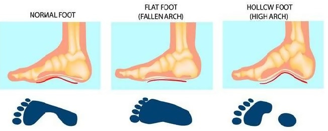 and illustration comparison of normal, fallen and high arch