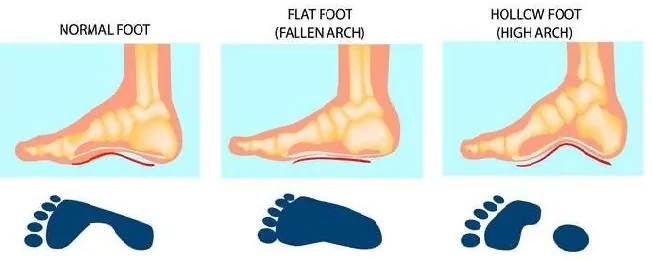 and illustration comparison of normal, fallen and high arch